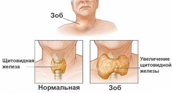 Что такое тиреоидит?