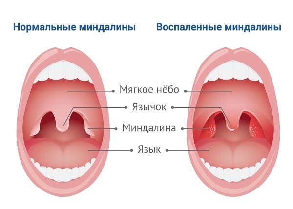 Хронический тонзиллит и армия: правовые аспекты и возможные последствия