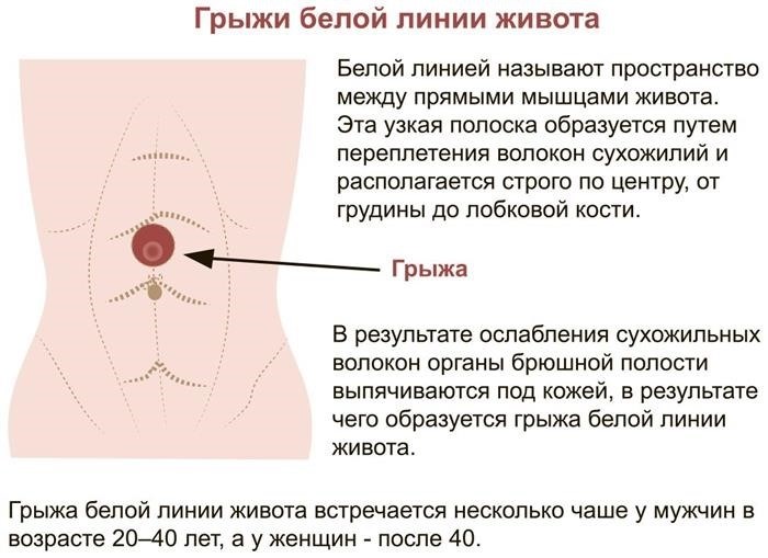 Симптомы диастаза прямых мышц живота