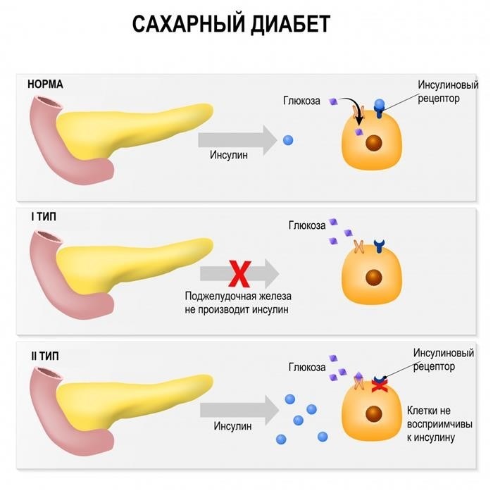 Прогноз и профилактика сахарного диабета 1 типа